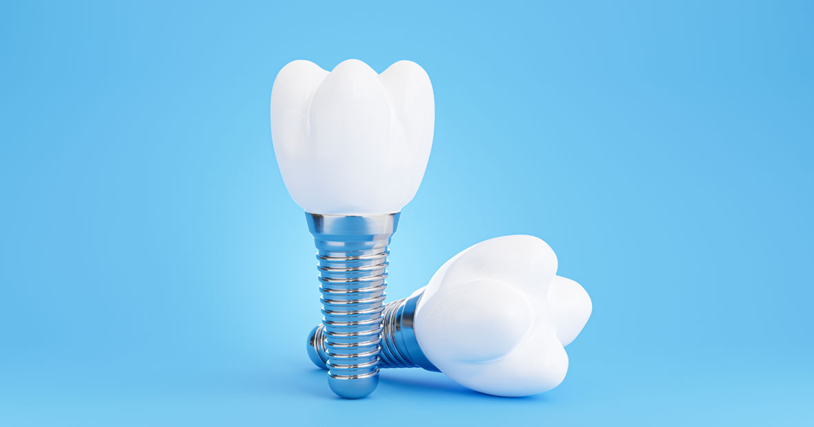 implant dentaire